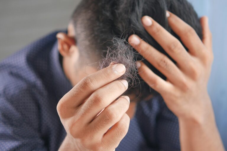 Excessive Hair Fall at a Young Age