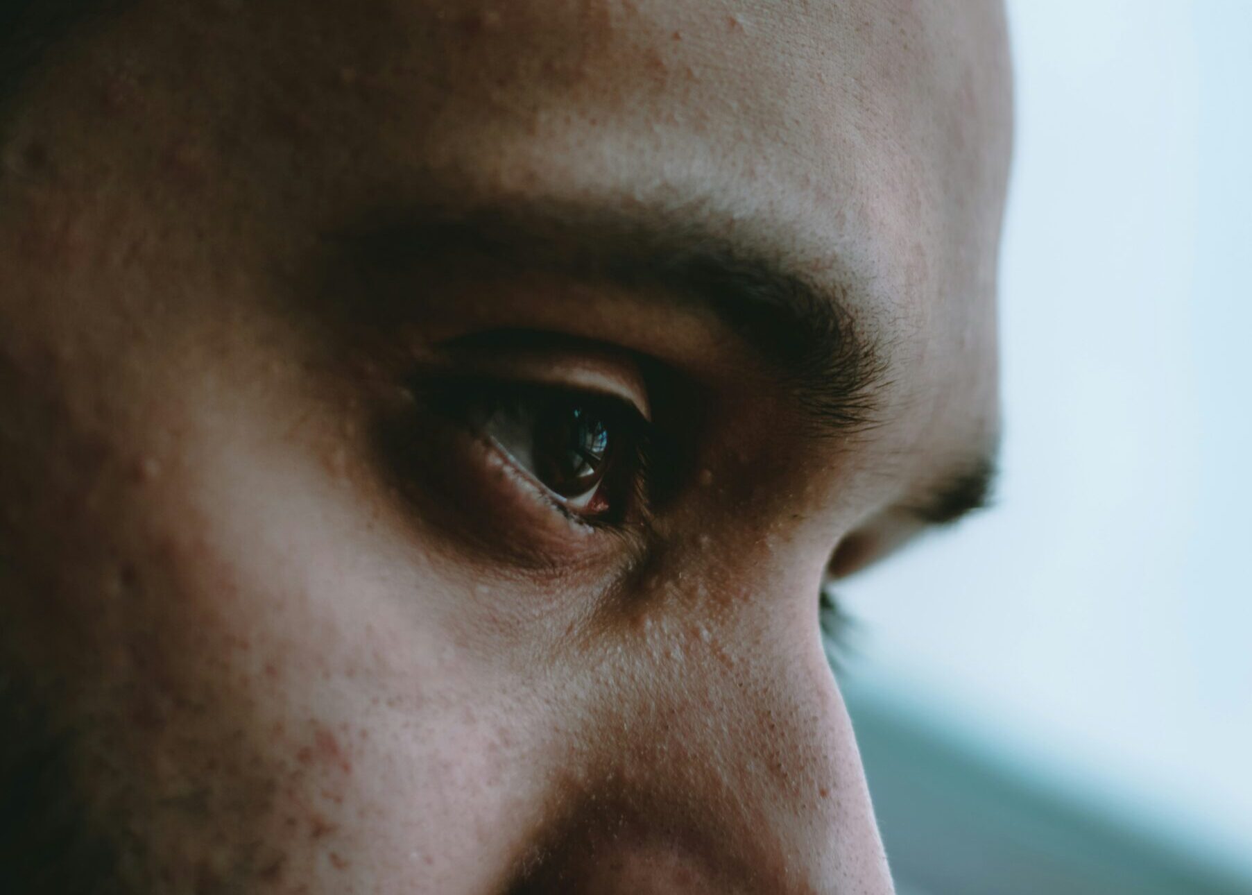 stress acne vs hormonal acne